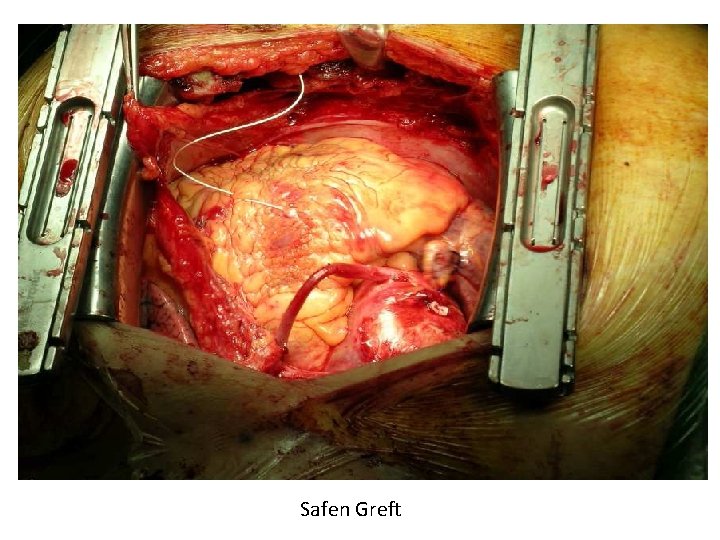 Safen Greft 