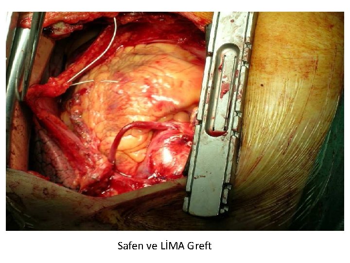 Safen ve LİMA Greft 