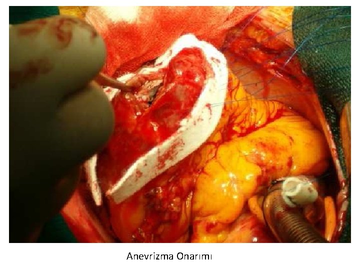 Anevrizma Onarımı 