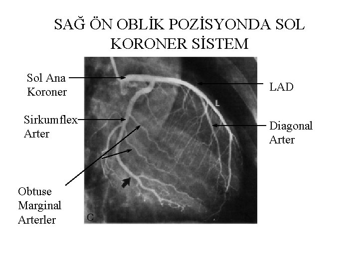SAĞ ÖN OBLİK POZİSYONDA SOL KORONER SİSTEM Sol Ana Koroner LAD Sirkumflex Arter Diagonal