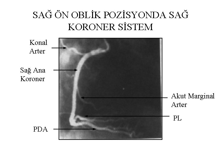 SAĞ ÖN OBLİK POZİSYONDA SAĞ KORONER SİSTEM Konal Arter Sağ Ana Koroner Akut Marginal