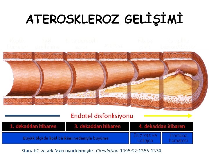 ATEROSKLEROZ GELİŞİMİ Köpük hücreleri Yağlı çizgilenme Orta dereceli lezyon Aterom Fibröz plak Komplike Lezyon/Rüptür
