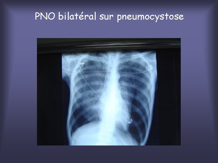 PNO bilatéral sur pneumocystose 