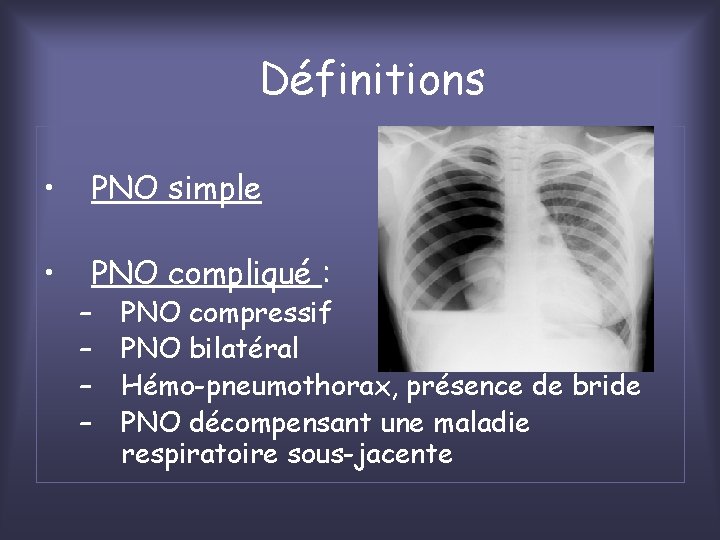 Définitions • PNO simple • PNO compliqué : – – PNO compressif PNO bilatéral