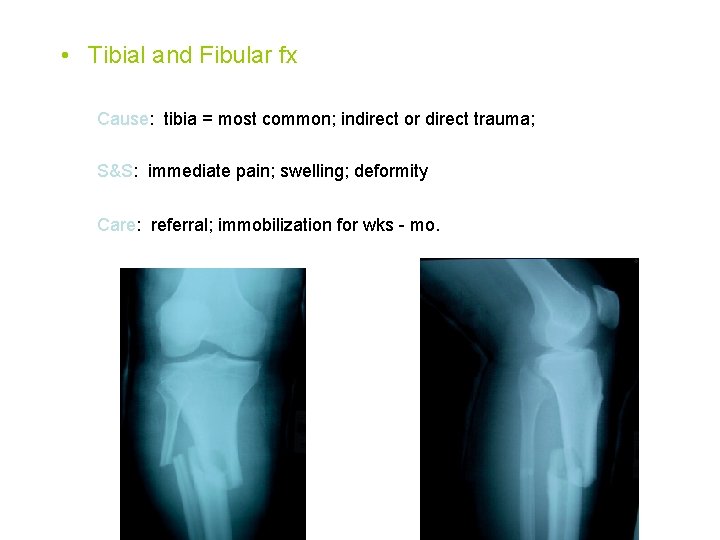  • Tibial and Fibular fx Cause: tibia = most common; indirect or direct