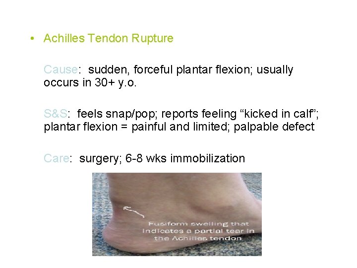  • Achilles Tendon Rupture Cause: sudden, forceful plantar flexion; usually occurs in 30+