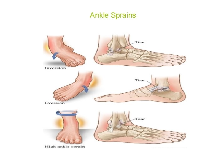 Ankle Sprains 