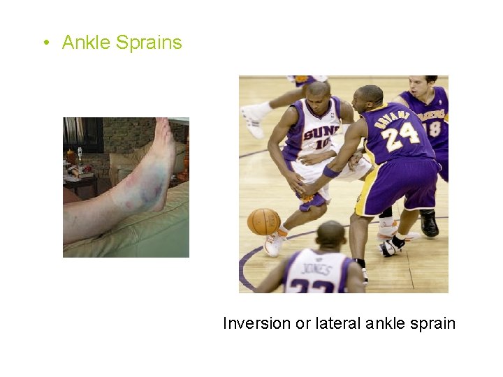  • Ankle Sprains Inversion or lateral ankle sprain 