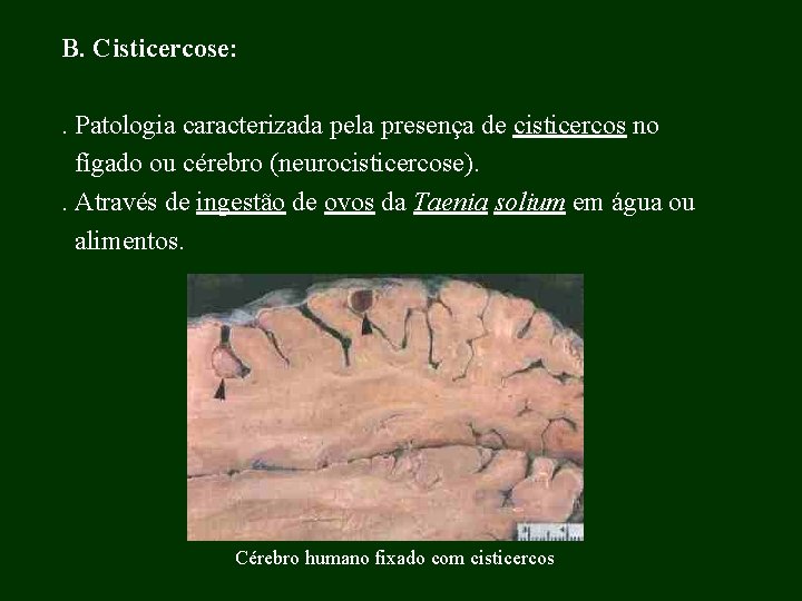 B. Cisticercose: . Patologia caracterizada pela presença de cisticercos no fígado ou cérebro (neurocisticercose).