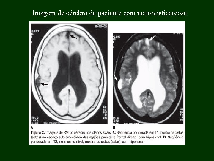 Imagem de cérebro de paciente com neurocisticercose 