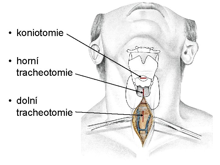 • koniotomie • horní tracheotomie • dolní tracheotomie • koniotomie • horní tracheotomie • dolní tracheotomie