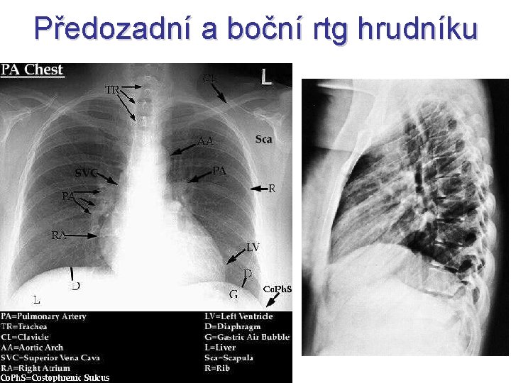Předozadní a boční rtg hrudníku Předozadní a boční rtg hrudníku