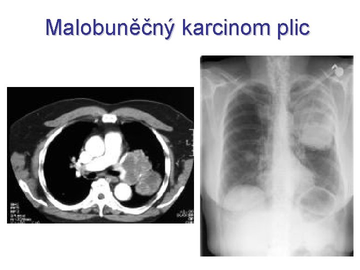 Malobuněčný karcinom plic Malobuněčný karcinom plic