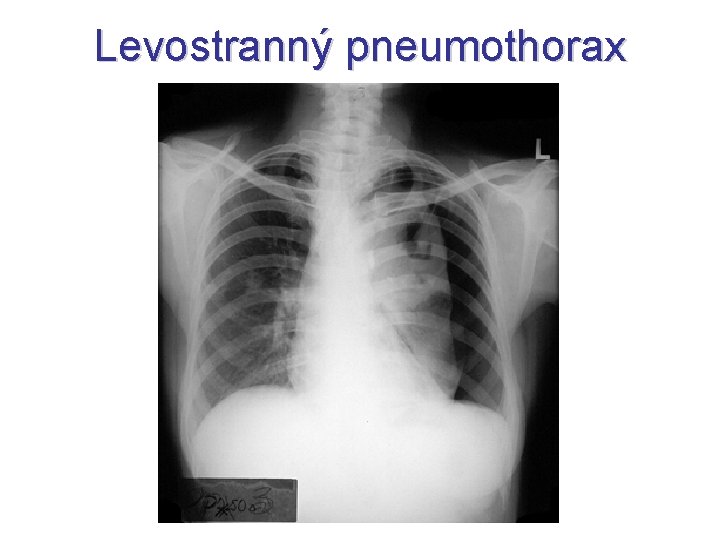 Levostranný pneumothorax Levostranný pneumothorax