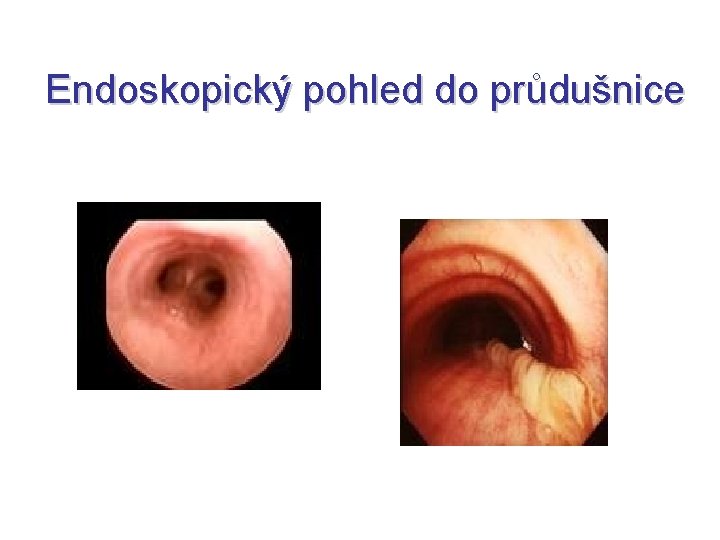 Endoskopický pohled do průdušnice Endoskopický pohled do průdušnice