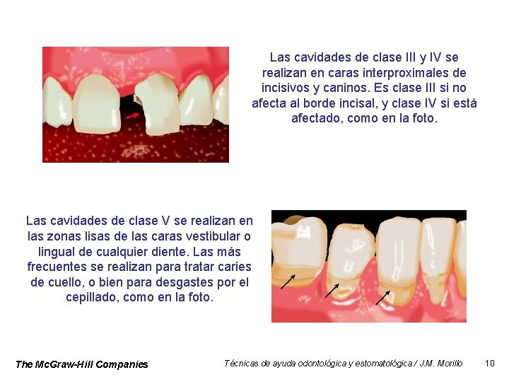 Las cavidades de clase III y IV se realizan en caras interproximales de incisivos