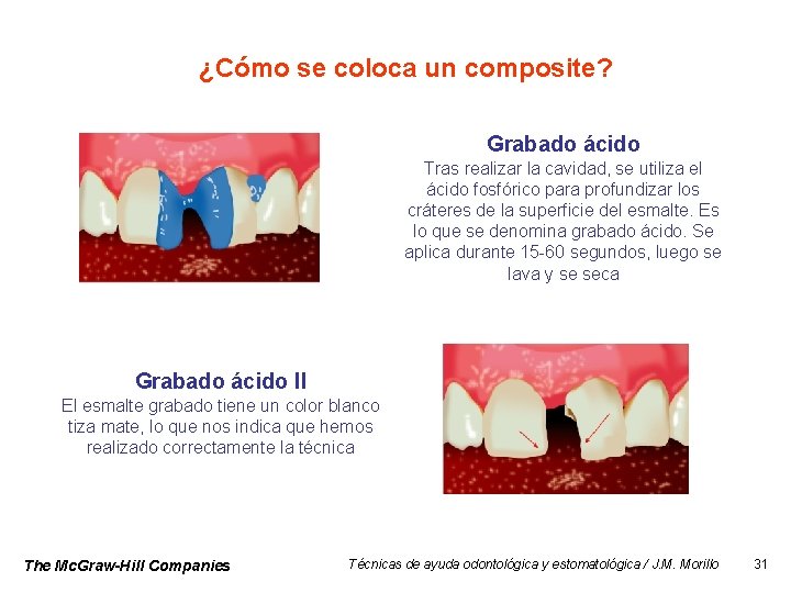 ¿Cómo se coloca un composite? Grabado ácido Tras realizar la cavidad, se utiliza el