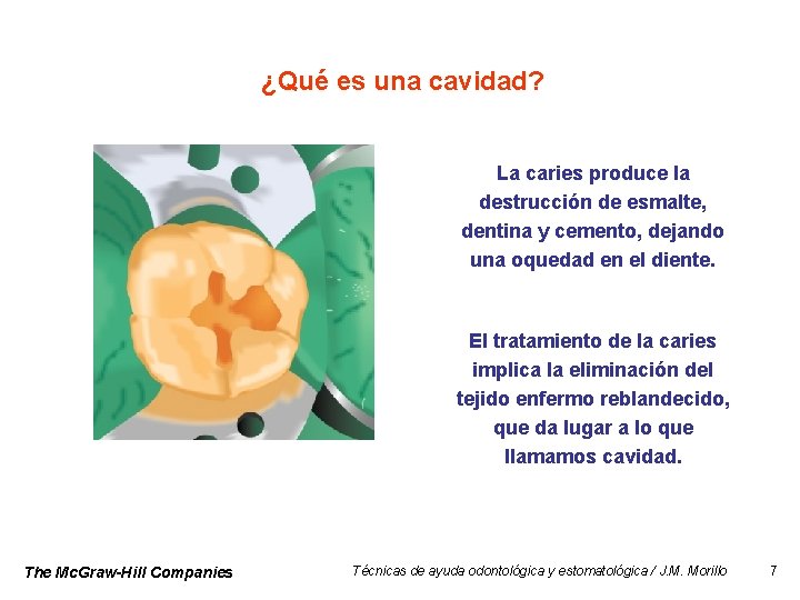 ¿Qué es una cavidad? La caries produce la destrucción de esmalte, dentina y cemento,