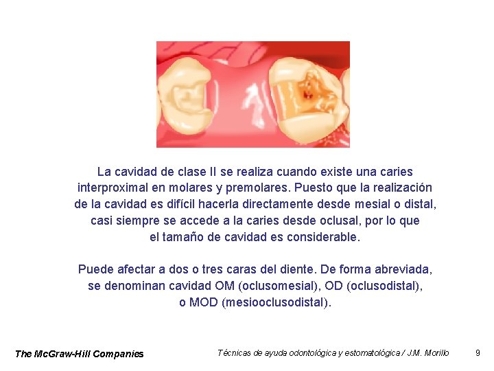 La cavidad de clase II se realiza cuando existe una caries interproximal en molares