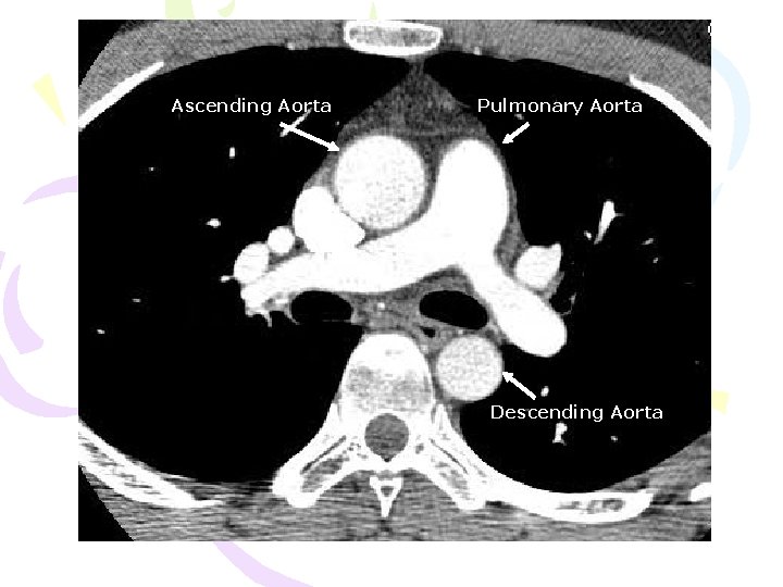 Ascending Aorta Pulmonary Aorta Descending Aorta 