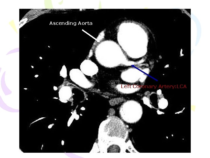 Ascending Aorta Left Coronary Artery: LCA 