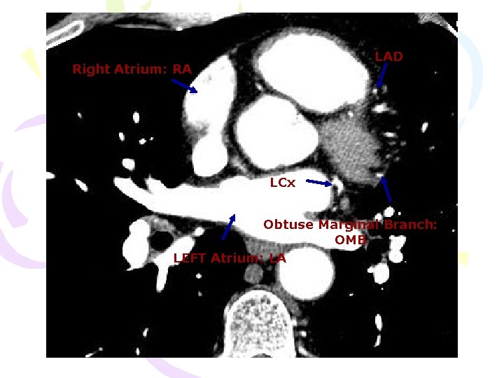 LAD Right Atrium: RA LCx Obtuse Marginal Branch: OMB LEFT Atrium: LA 