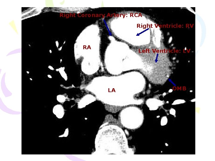 Right Coronary Artery: RCA Right Ventricle: RV RA Left Ventricle: LV LA OMB 
