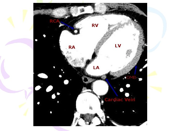 RCA RV LV RA LA OMB Cardiac Vein 