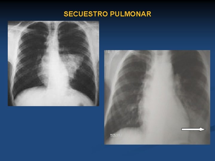 SECUESTRO PULMONAR 