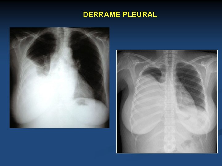 DERRAME PLEURAL 