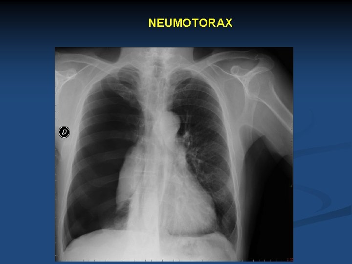 NEUMOTORAX 