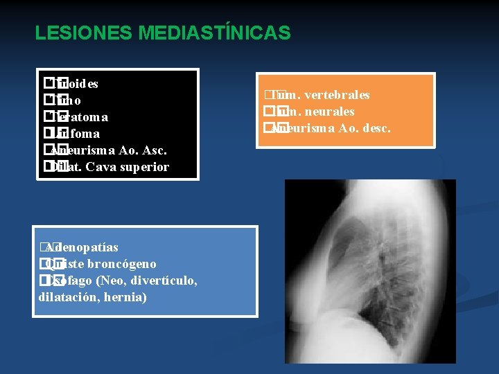 LESIONES MEDIASTÍNICAS �� Tiroides �� Timo �� Teratoma �� Linfoma �� Aneurisma Ao. Asc.