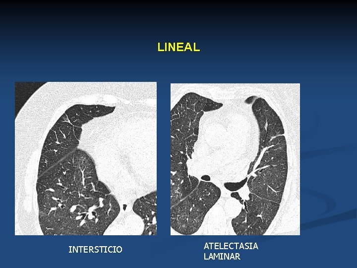 LINEAL INTERSTICIO ATELECTASIA LAMINAR 