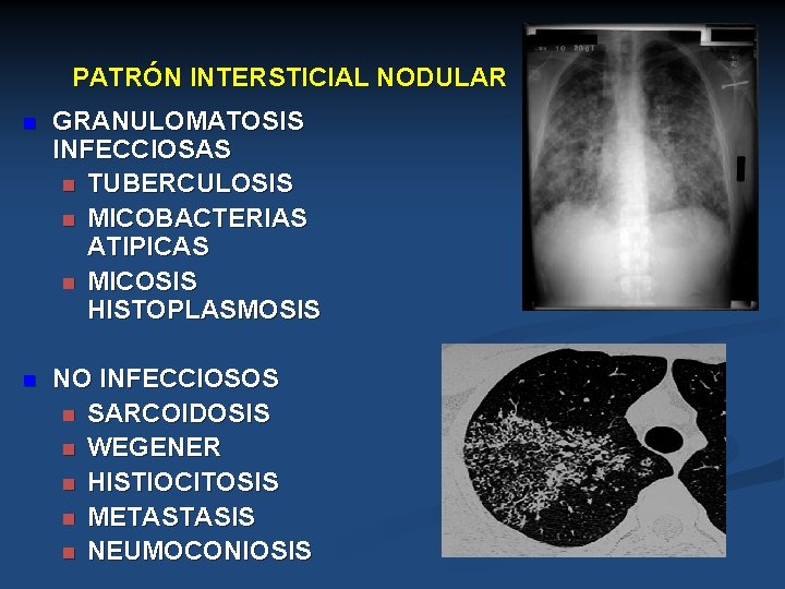 PATRÓN INTERSTICIAL NODULAR n GRANULOMATOSIS INFECCIOSAS n TUBERCULOSIS n MICOBACTERIAS ATIPICAS n MICOSIS HISTOPLASMOSIS