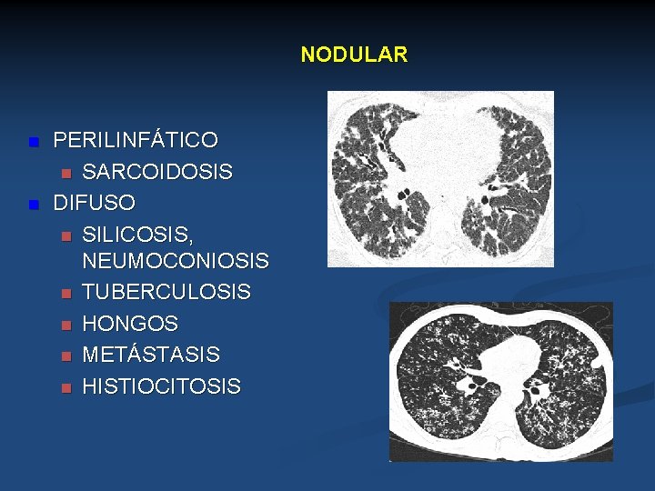 NODULAR n n PERILINFÁTICO n SARCOIDOSIS DIFUSO n SILICOSIS, NEUMOCONIOSIS n TUBERCULOSIS n HONGOS