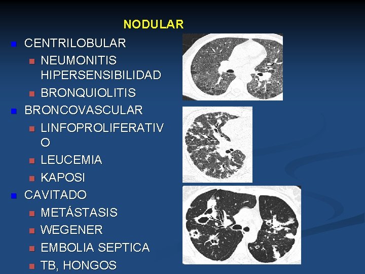 NODULAR n n n CENTRILOBULAR n NEUMONITIS HIPERSENSIBILIDAD n BRONQUIOLITIS BRONCOVASCULAR n LINFOPROLIFERATIV O