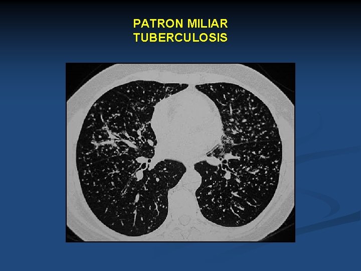 PATRON MILIAR TUBERCULOSIS 