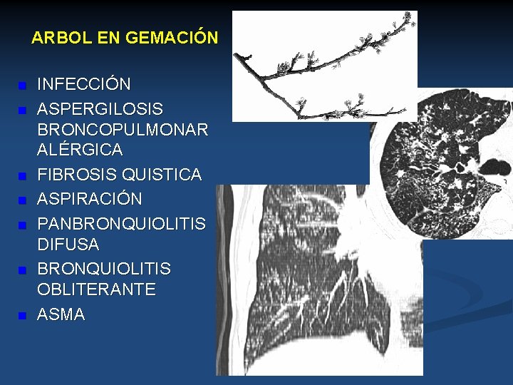 ARBOL EN GEMACIÓN n n n n INFECCIÓN ASPERGILOSIS BRONCOPULMONAR ALÉRGICA FIBROSIS QUISTICA ASPIRACIÓN