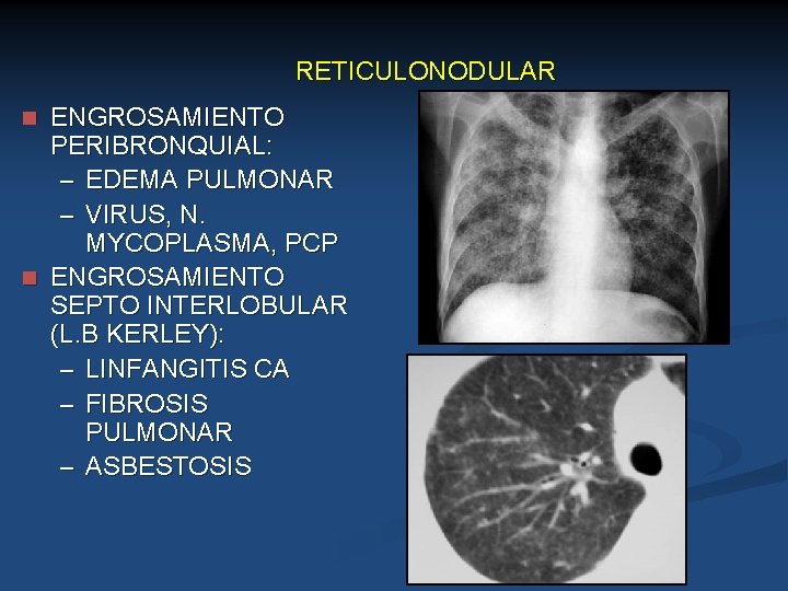 RETICULONODULAR ENGROSAMIENTO PERIBRONQUIAL: – EDEMA PULMONAR – VIRUS, N. MYCOPLASMA, PCP n ENGROSAMIENTO SEPTO