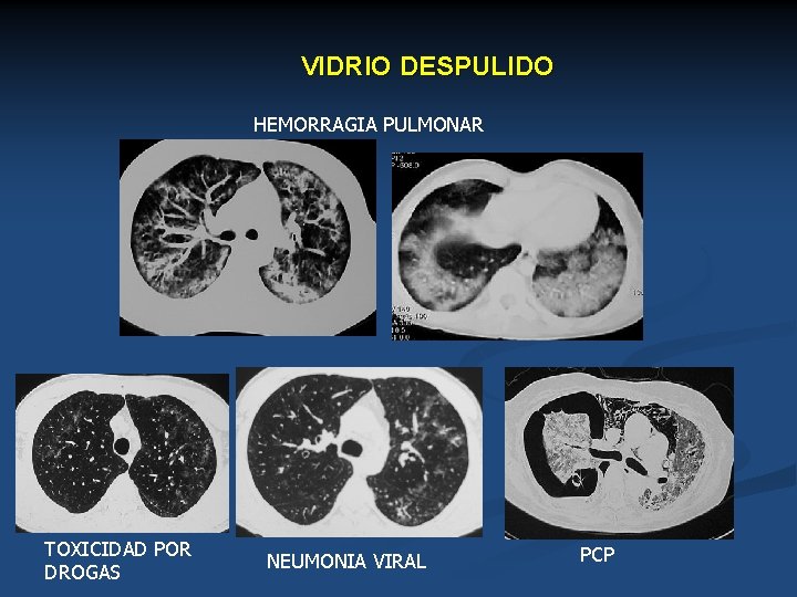 VIDRIO DESPULIDO HEMORRAGIA PULMONAR TOXICIDAD POR DROGAS NEUMONIA VIRAL PCP 