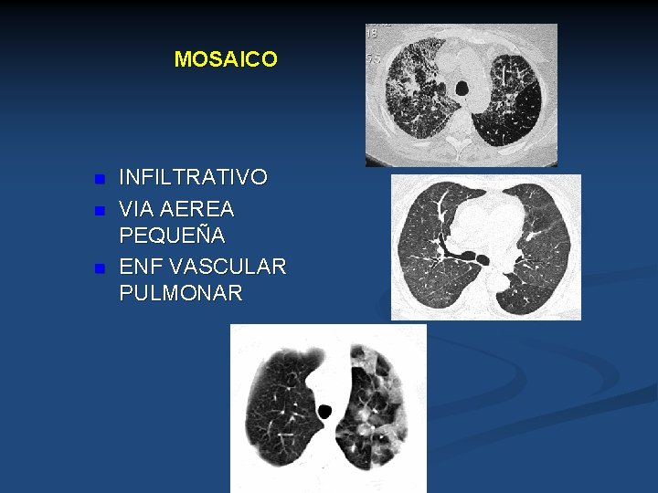 MOSAICO n n n INFILTRATIVO VIA AEREA PEQUEÑA ENF VASCULAR PULMONAR 