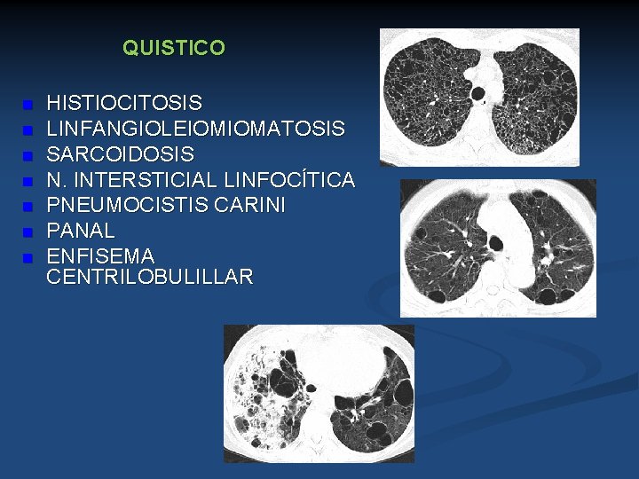 QUISTICO n n n n HISTIOCITOSIS LINFANGIOLEIOMIOMATOSIS SARCOIDOSIS N. INTERSTICIAL LINFOCÍTICA PNEUMOCISTIS CARINI PANAL