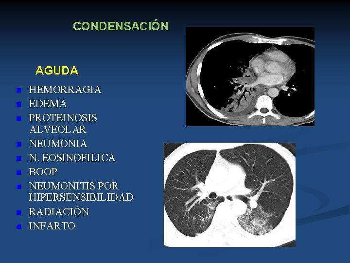 CONDENSACIÓN AGUDA n n n n n HEMORRAGIA EDEMA PROTEINOSIS ALVEOLAR NEUMONIA N. EOSINOFILICA