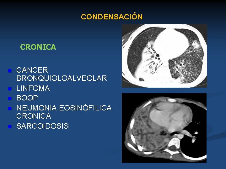 CONDENSACIÓN CRONICA n n n CANCER BRONQUIOLOALVEOLAR LINFOMA BOOP NEUMONIA EOSINÓFILICA CRONICA SARCOIDOSIS 