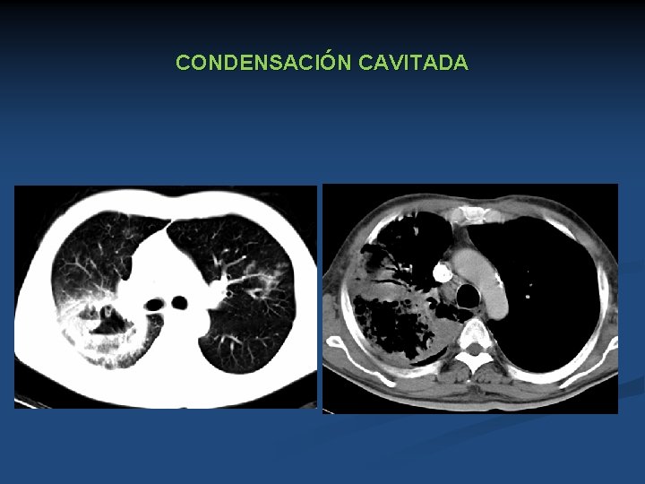 CONDENSACIÓN CAVITADA 