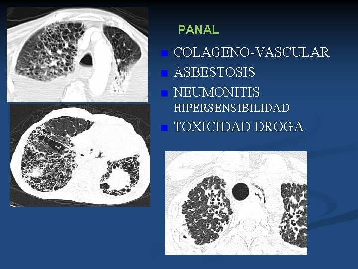 PANAL n n n COLAGENO-VASCULAR ASBESTOSIS NEUMONITIS HIPERSENSIBILIDAD n TOXICIDAD DROGA 