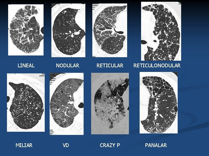 LINEAL MILIAR NODULAR VD RETICULAR RETICULONODULAR CRAZY P PANALAR 