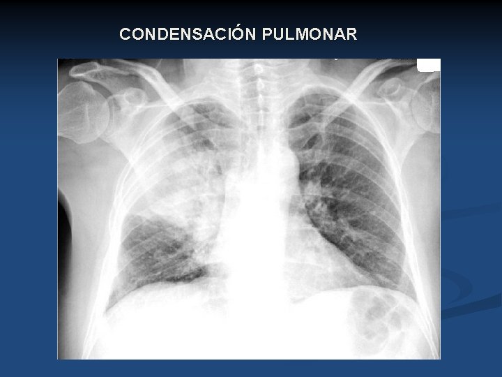 CONDENSACIÓN PULMONAR 