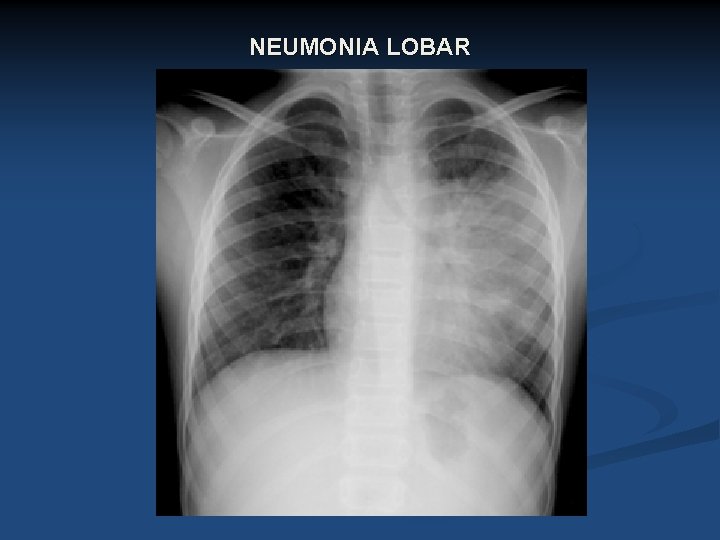 NEUMONIA LOBAR 