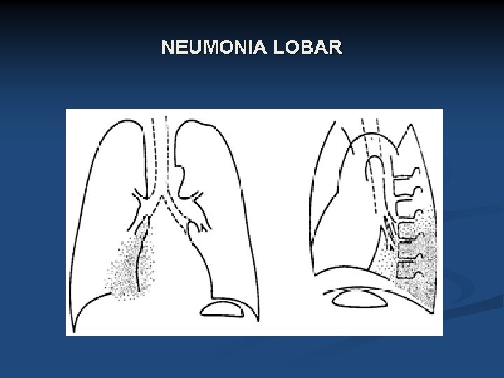 NEUMONIA LOBAR 